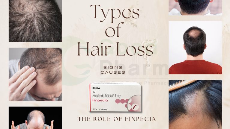 Types of Hair loss: Signs, Causes and the Role of Finpecia