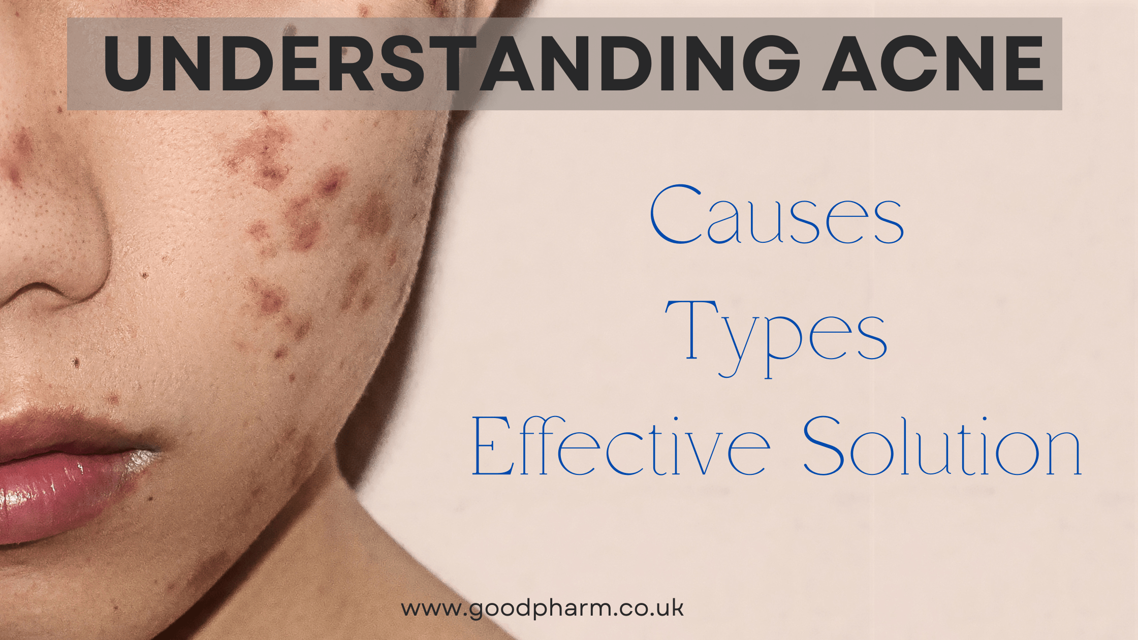Understanding Acne: Causes, Types, and Effective Solutions